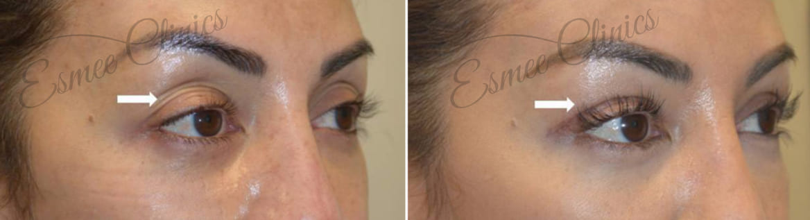 Before and After img